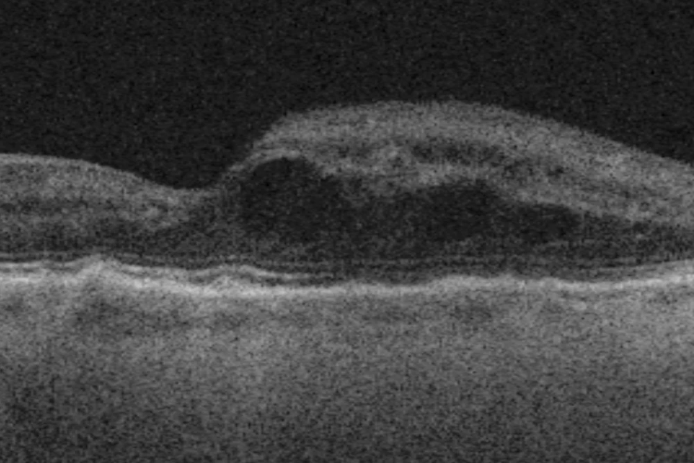 Privatdozent Vetter Makula Analyse