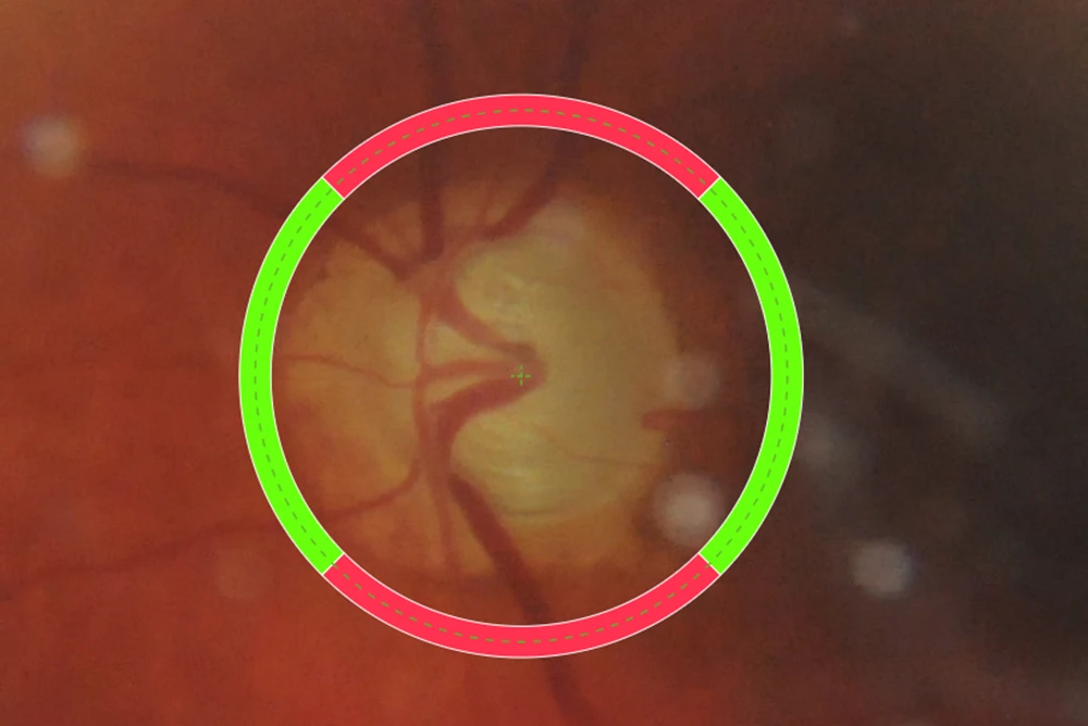 Privatdozent Vetter Sehnerven Analyse